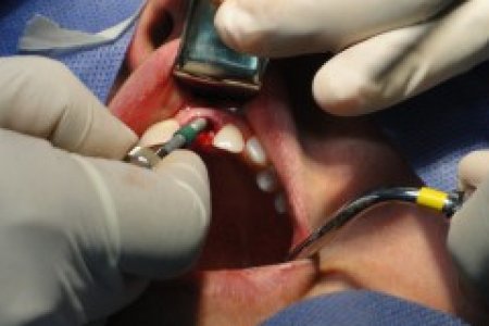 IMPLANTE DENTAL