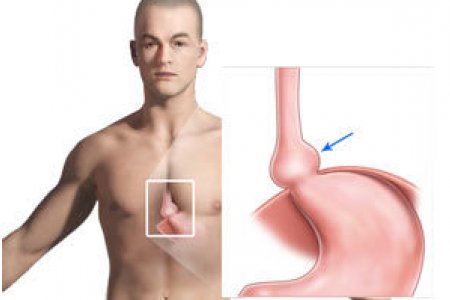 QUE ES HERNIA DE HIATO