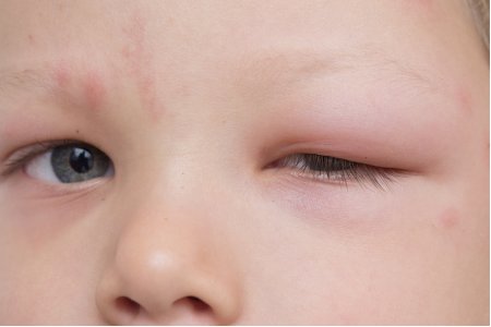TRATAMIENTO PARA EL HINCHAZÓN DE OJOS