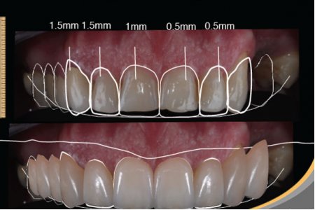 DISEÑO DIGITAL DE SONRISA