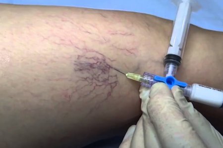 ESCLEROTERAPIA