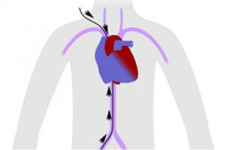 CATETERISMO CARDIACO DIAGNOSTICO