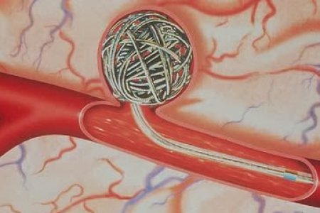 EMBOLIZACION  Y TROMBOSIS