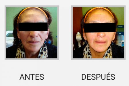 RELLENOS FACIALES
