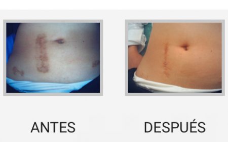 MICRODERMOABRASION