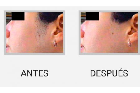 DEPILACION PROLONGADA