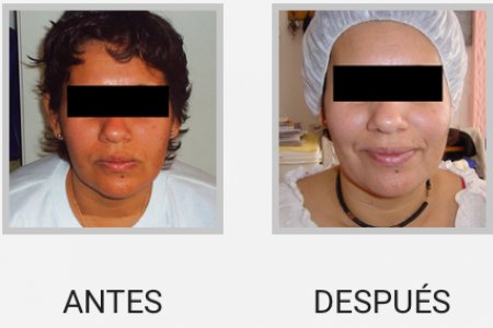 PEELING QUIMICO
