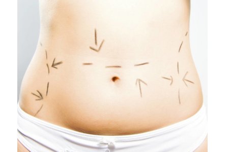 DERMOLIPECTOMIA ABDOMINAL