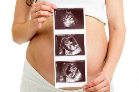 AMNIOCENTESIS