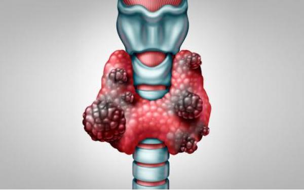CÁNCER DE TIROIDES