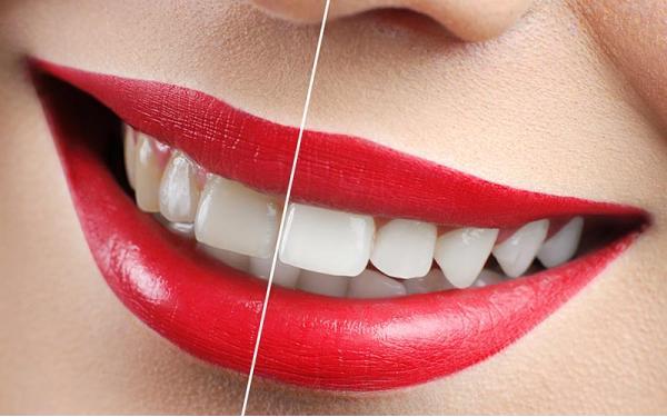 Blanqueamiento Dental