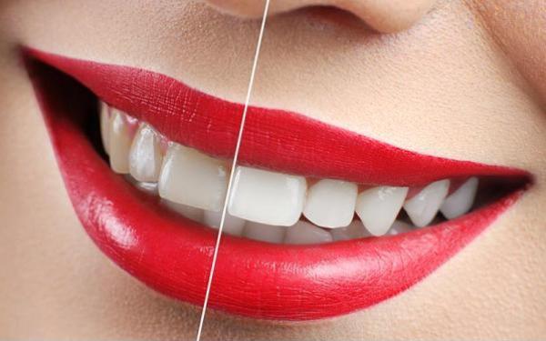 Blanqueamiento Dental