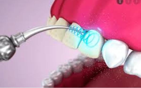 Periodoncia con Ultrasonido