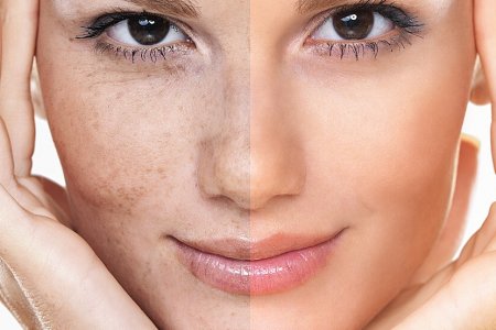 REJUVENECIMIENTO FACIAL
