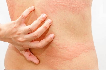 URTICARIA Y ALERGIAS