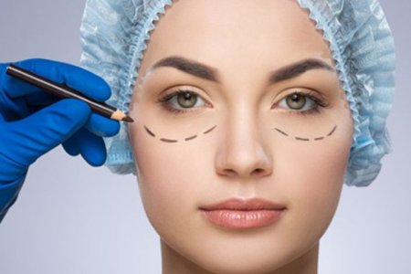 BLEFAROPLASTIA 