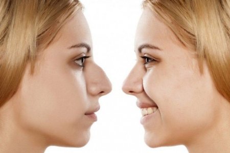 RINOPLASTIA
