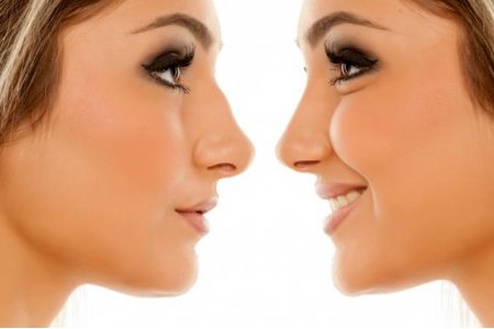 RINOPLASTIA