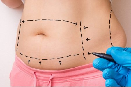 ABDOMINOPLASTIA