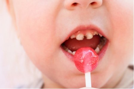 CARIES INFANTIL