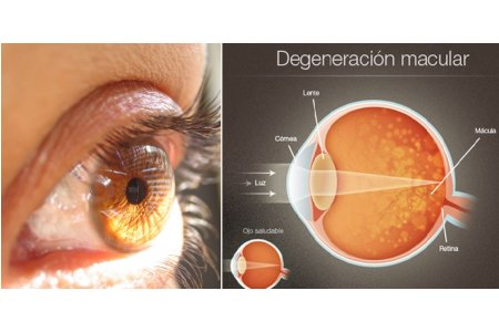 DIAGNÓSTICO DE DEGENERACION MACULAR