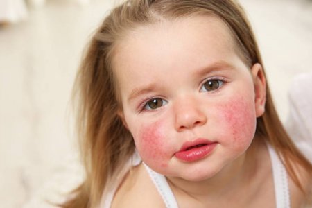 ROSACEA