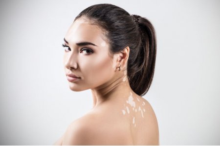 VITILIGO