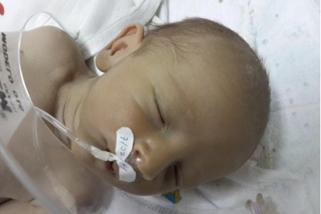ATRESIA ESOFÁGICA
