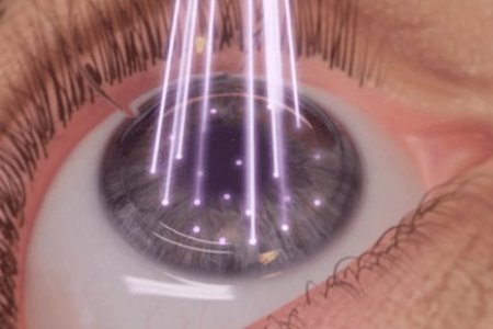 CIRUGÍA REFRACTIVA