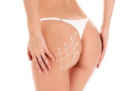 IMPLANTES DE GLUTEO