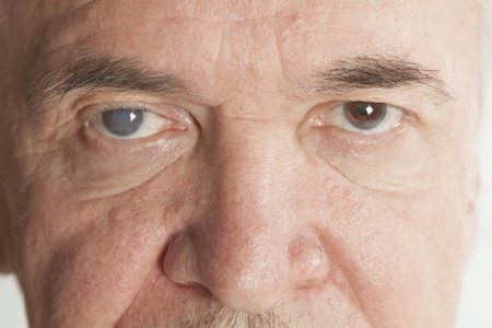 DEGENERACIÓN MACULAR