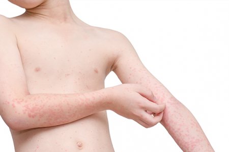 URTICARIA CRÓNICA
