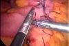 CIRUGIA COLORRECTAL