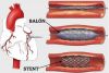 ANGIOPLASTIA PERCUTANEA CORONARIA
