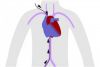CATETERISMO CARDIACO DIAGNOSTICO