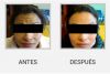 TRATAMIENTO CON BOTOX