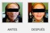 RELLENOS FACIALES