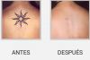 BORRADO DE TATUAJES