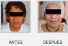 PEELING QUIMICO
