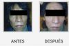PLASMA RICO EN PLAQUETAS