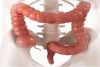 CIRUGIA COLORECTAL