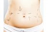 DERMOLIPECTOMIA ABDOMINAL