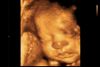 ECOGRAFIA FETAL