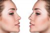 CIRUGIA ESTÉTICA Y FUNCIONAL DE NARIZ