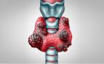 CÁNCER DE TIROIDES