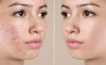 TRATAMIENTOS PARA EL ACNE