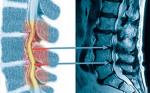 ESTENOSIS LUMBAR