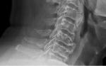 ESPONDILODISCITIS PIÓGENA