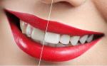 Blanqueamiento Dental
