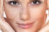 REJUVENECIMIENTO FACIAL